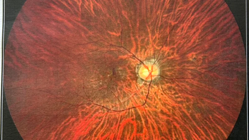 Imagem detalhada da retina humana, mostrando a estrutura vascular e a distribuição do nervo óptico, em cores vivas e textura complexa. Jovem realiza vaquinha para auxiliar no pagamento do tratamento de Degeneração Macular
